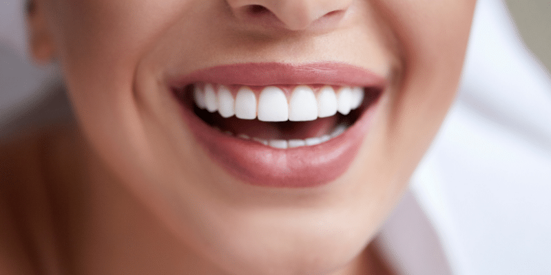 ציפויי חרסינה לשיניים – הטרנד שכבש את העולם, מעודכן ל- 2021