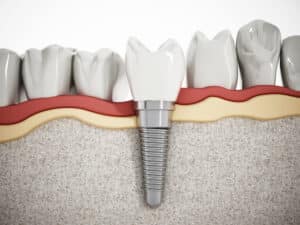 מה מותר ומה אסור לאחר השתלת שיניים