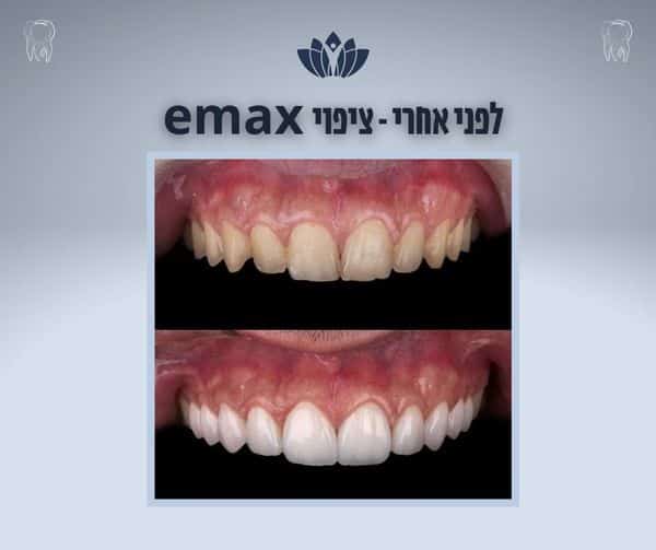 ציפויי שיניים EMAX עבודה מדהימה