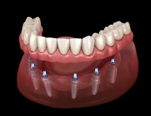 היתרונות בהשתלת שיניים בשיטת אול און פור ואול און סיקס ALL ON  כל מה שצריך לדעת
