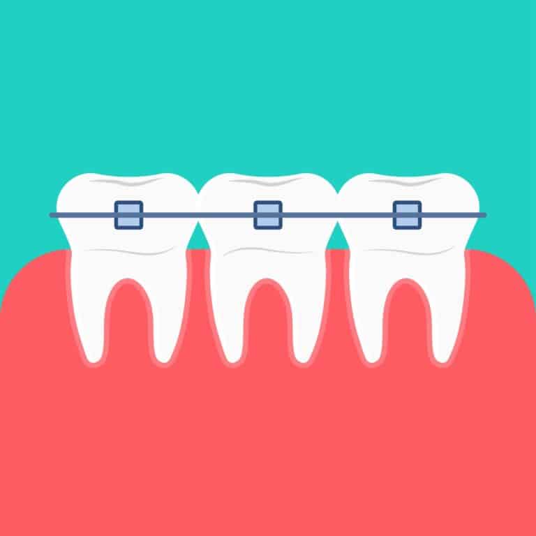 כל השיטות ליישור שיניים יתרונות וחסרונות