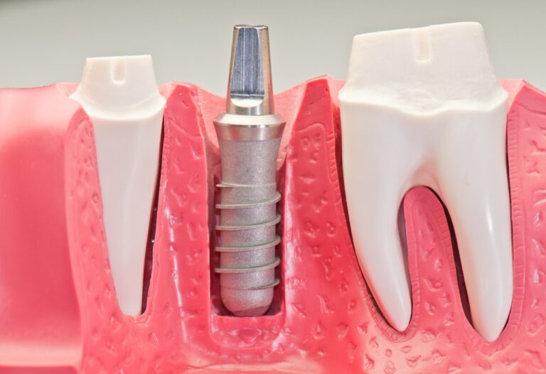 כל מה שצריך לדעת על השתלת שיניים בזאלית כמה זה עולה כמה זמן לוקח והחלמה