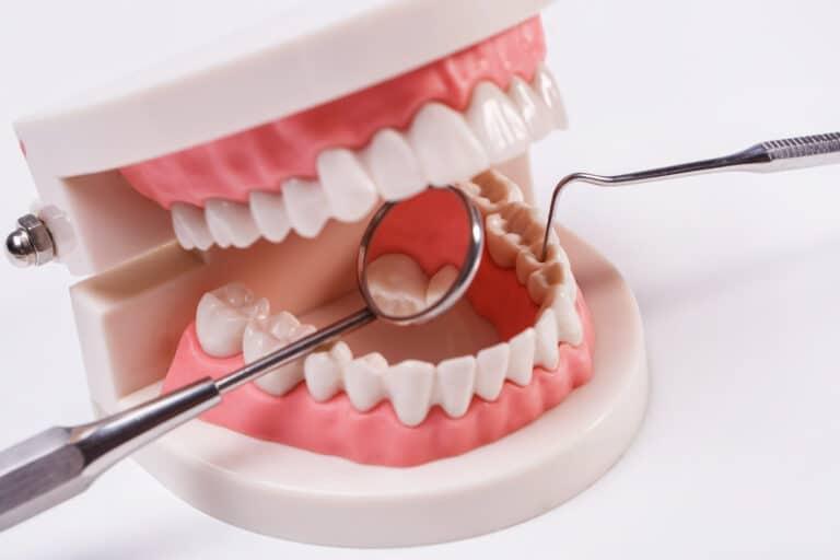 השתלות שיניים ללא השתלת עצם