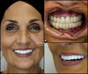 החיוך של אילנה להתגבר על נסיגה חמורה בשיניים עם מומחיות כירורגית