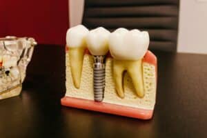 השתלת שיניים היא דרך פופולרית ויעילה להחליף שיניים חסרות.
