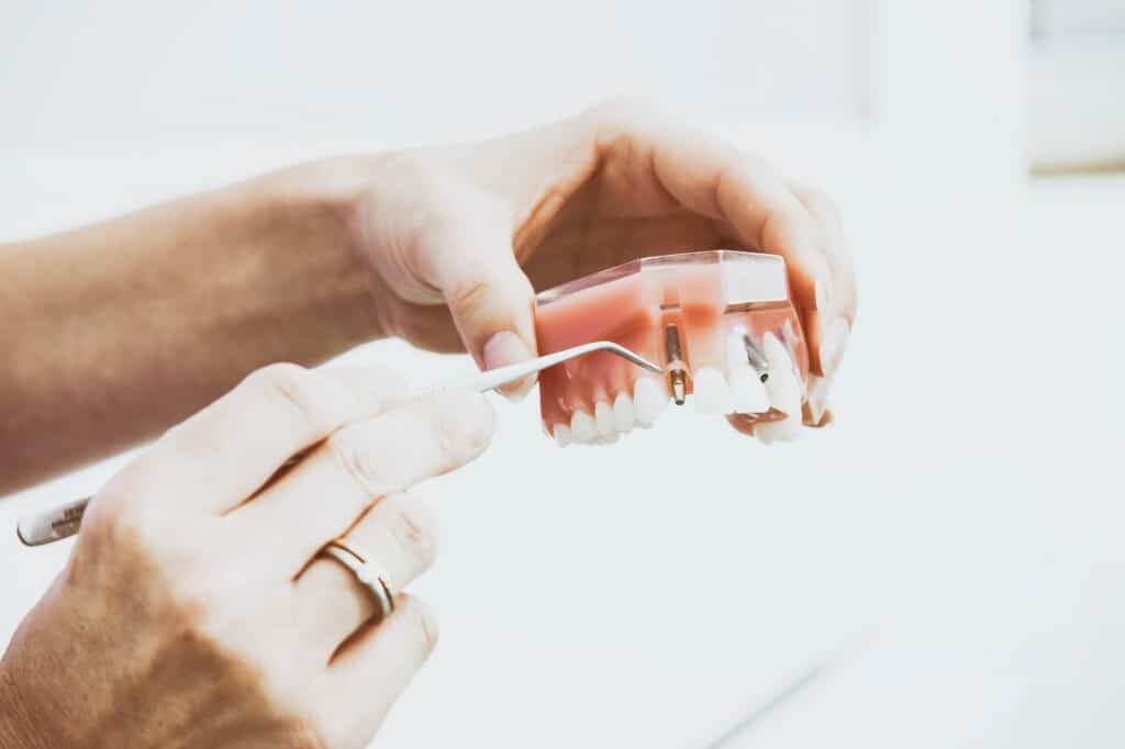 זוהי אפשרות פופולרית להחלפת שיניים חסרות מכיוון שהיא מספקת פתרון חזק, קבוע ובעל מראה טבעי.
