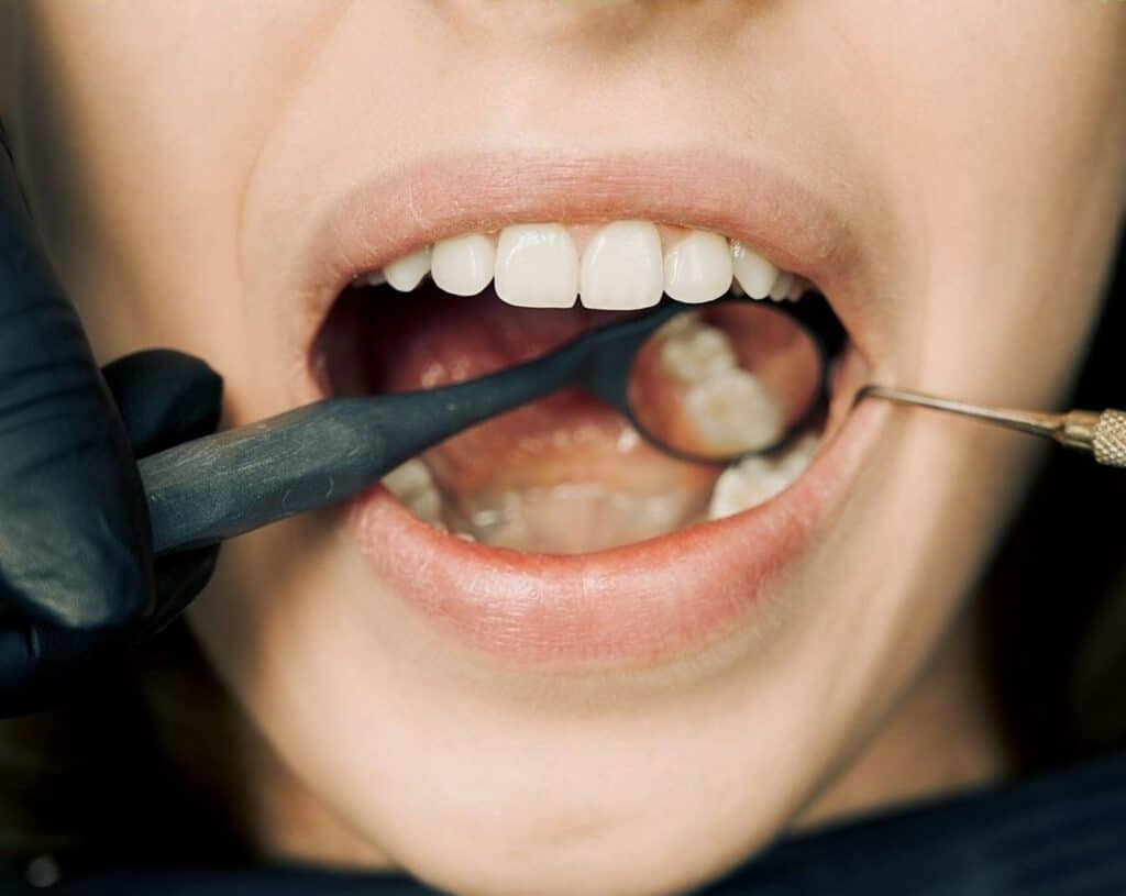 טיפול שורש הוא הליך שמסיר עיסה נגועה או פגומה מתוך השן.
