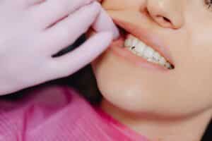 כתרי זירקוניה מספקים תוצאה בעלת מראה טבעי יותר מאשר ציפוי שיניים.
