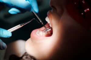 ציפוי שיניים Emax הינו אסתטי ביותר ומעניק מראה טבעי לשיניים.
