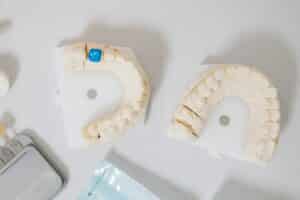 ציפוי שיניים פחות פולשני ופחות יקר מכתרי זירקוניה.
