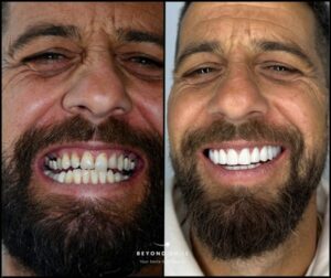 שינוי השיניים המהיר של טורקיה תוך שבוע.
